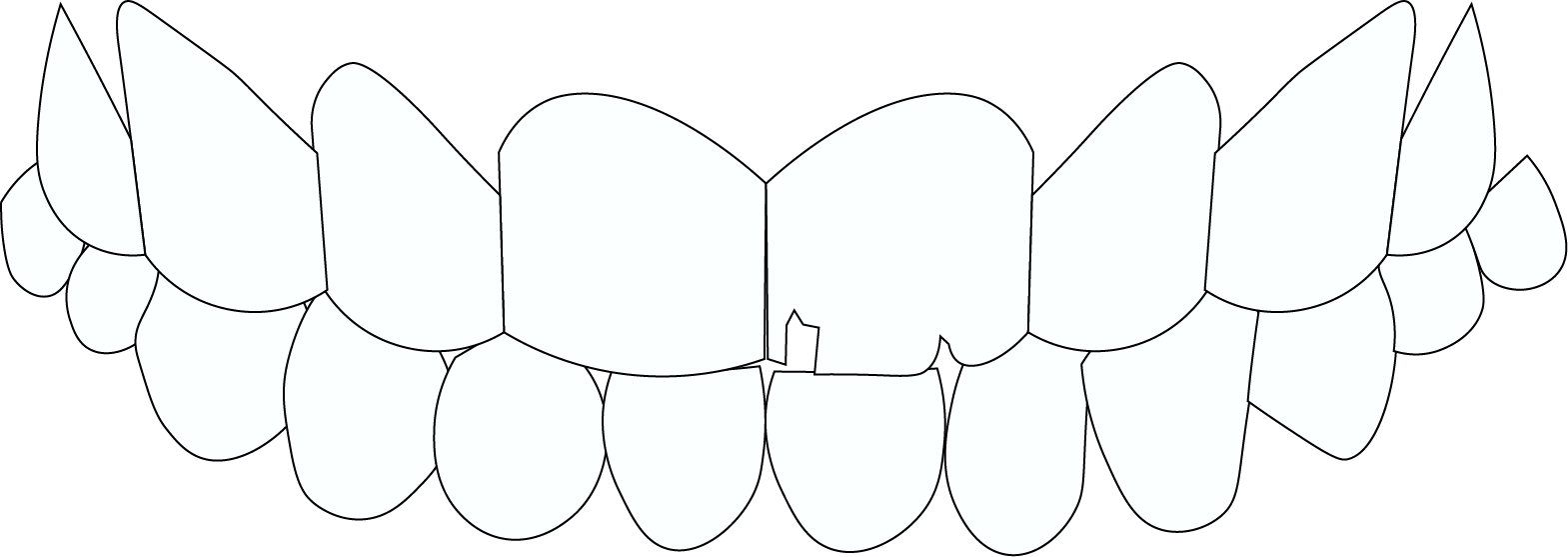 CHIPPED TEETH