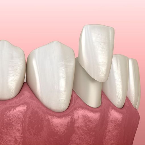 porcelain veneers
