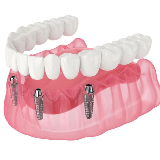 dental implants