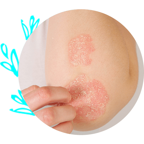 Psoriasis — Virginia Beach, VA — Dermatology Inc of Virginia Beach Psoriasis — Virginia Beach, VA — Dermatology Inc of Virginia Beach