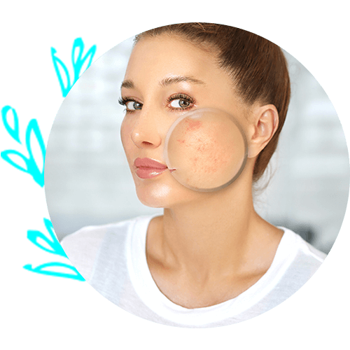 Woman with Rosacea — Virginia Beach, VA — Dermatology Inc of Virginia Beach Woman with Rosacea — Virginia Beach, VA — Dermatology Inc of Virginia Beach