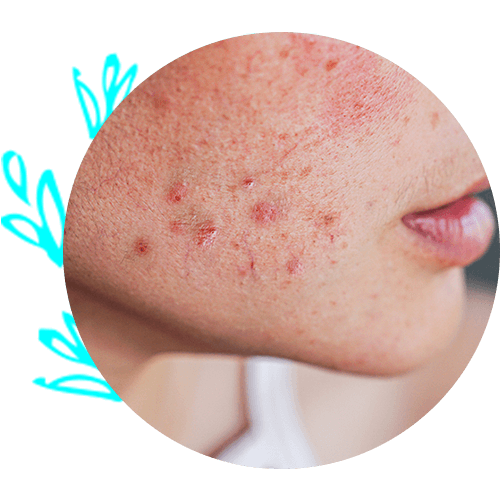 Acne on Woman's Face — Virginia Beach, VA — Dermatology Inc of Virginia Beach Acne on Woman's Face — Virginia Beach, VA — Dermatology Inc of Virginia Beach
