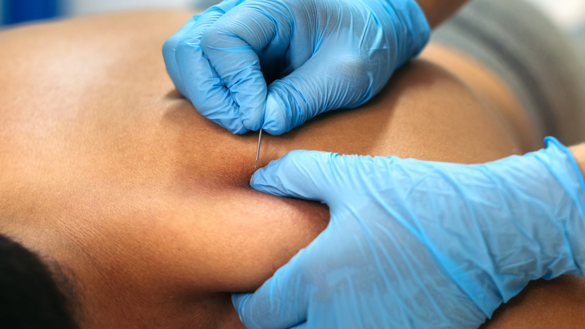 Gloved hands examining skin during a medical procedure