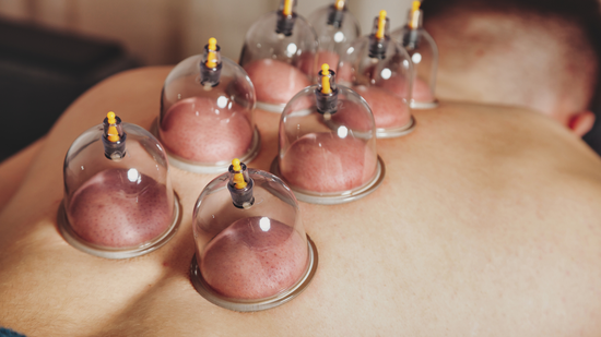 Cupping therapy cups attached to a person’s bare back.