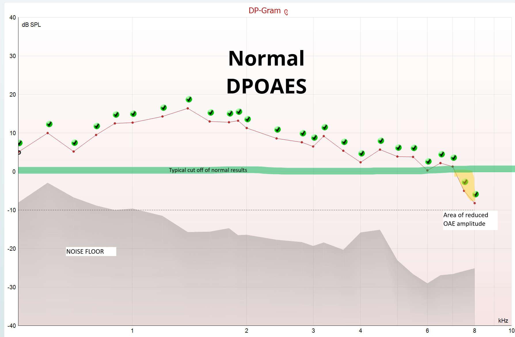 Chart showing normal DPOAES results, with a fluctuating green dotted line over a gray background.