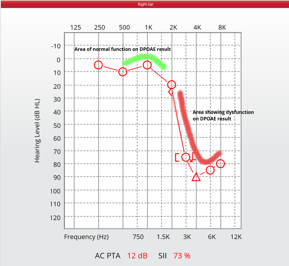 Audiogram showing right ear hearing test results with a sloping hearing loss and a speech understanding score of 73%.