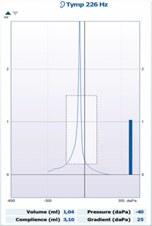 Tympanogram graph. A peak at -40 daPa, volume 1.04 ml, compliance 3.10 ml, gradient 25 daPa.