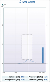 Tympanogram graph. Volume: 0.63ml, compliance: 0.19ml, pressure: 15 daPa, gradient: 175 daPa.