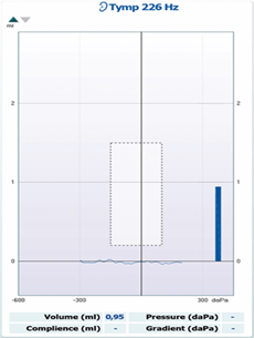 Tympanogram graph. Shows a flat line, then a spike. Volume is 0.95 ml. No other values are present.