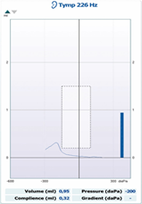 Tympanogram graph: flat line, consistent with type B tympanogram, indicating middle ear fluid or obstruction.