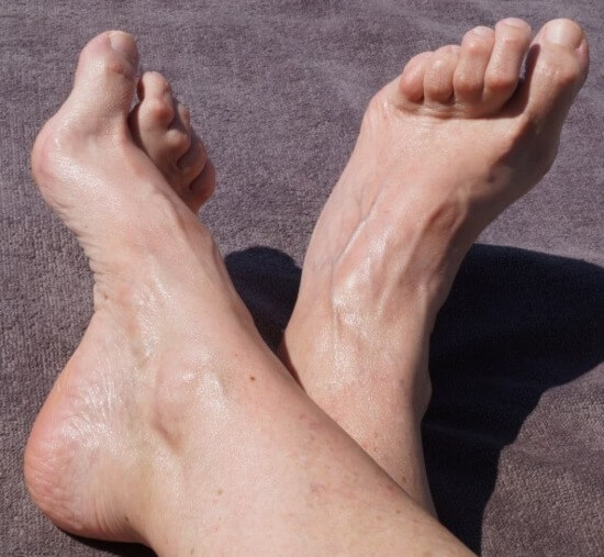 A close-up of bare feet in Seaford, DE showcasing hammertoe deformity