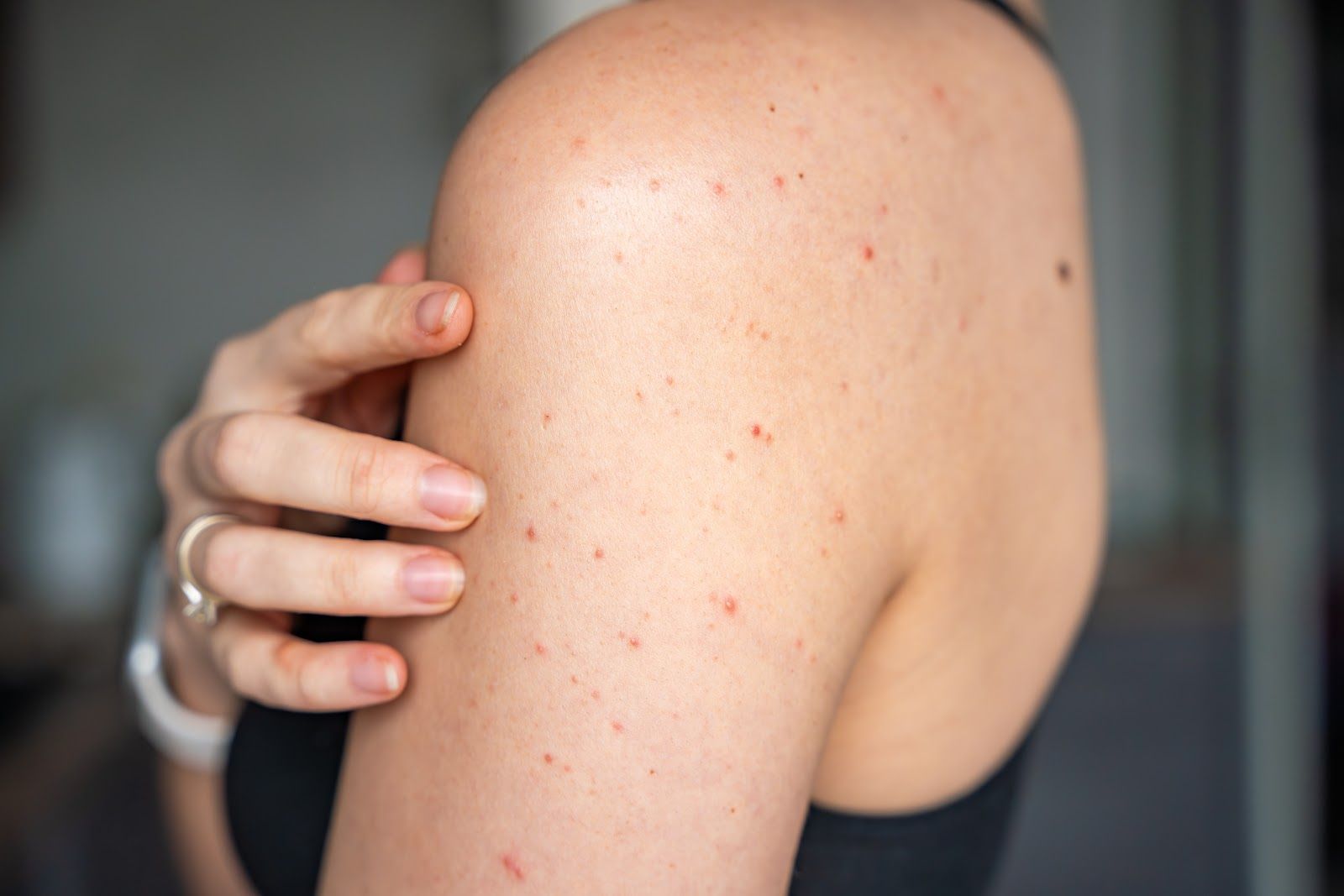 Close-up of a bare shoulder with a hand touching a red, spotty rash on the skin