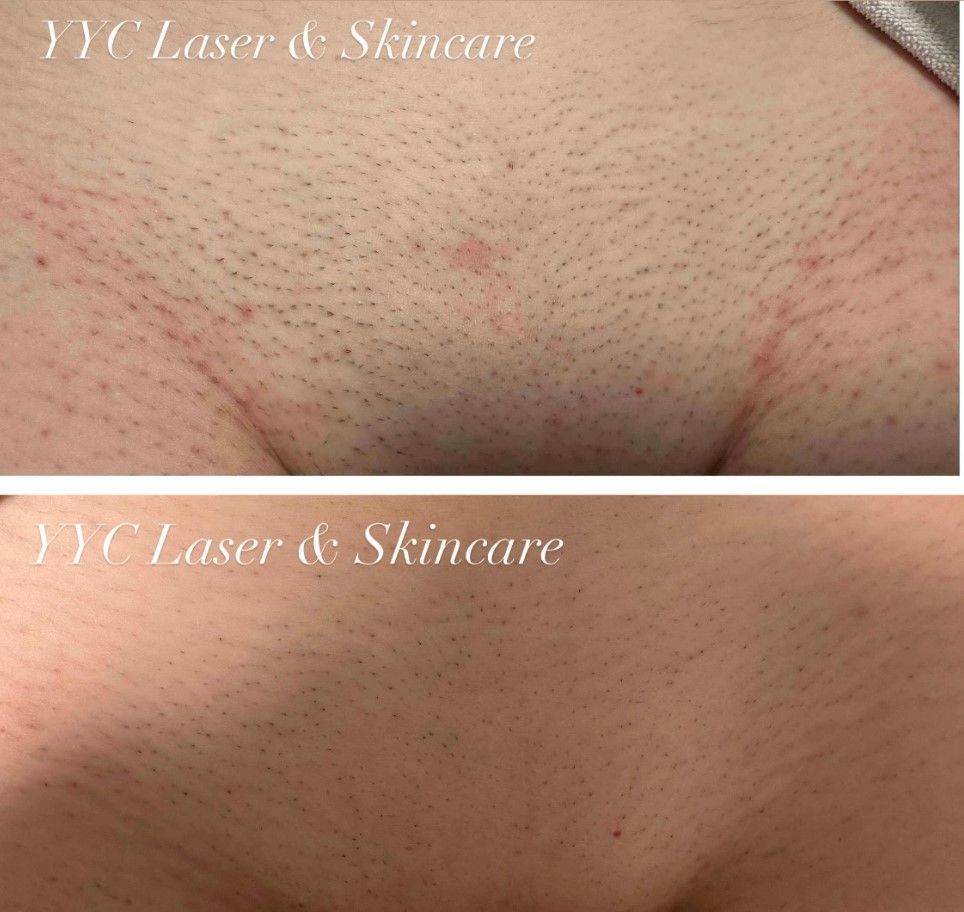Before-and-after close-up of skin with short dark stubble and mild redness, labeled YYC Laser & Skincare.