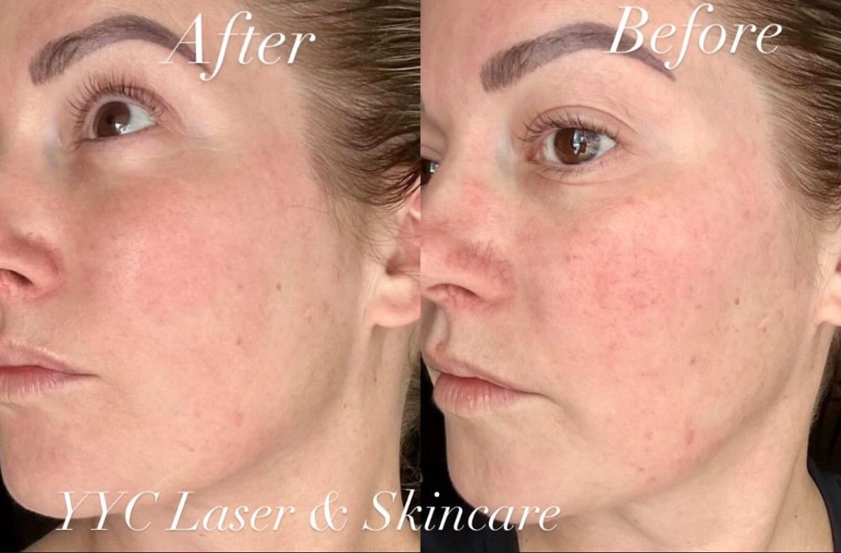 Before-and-after close-up of a woman's cheek showing skin improvement after IPL laser treatment.