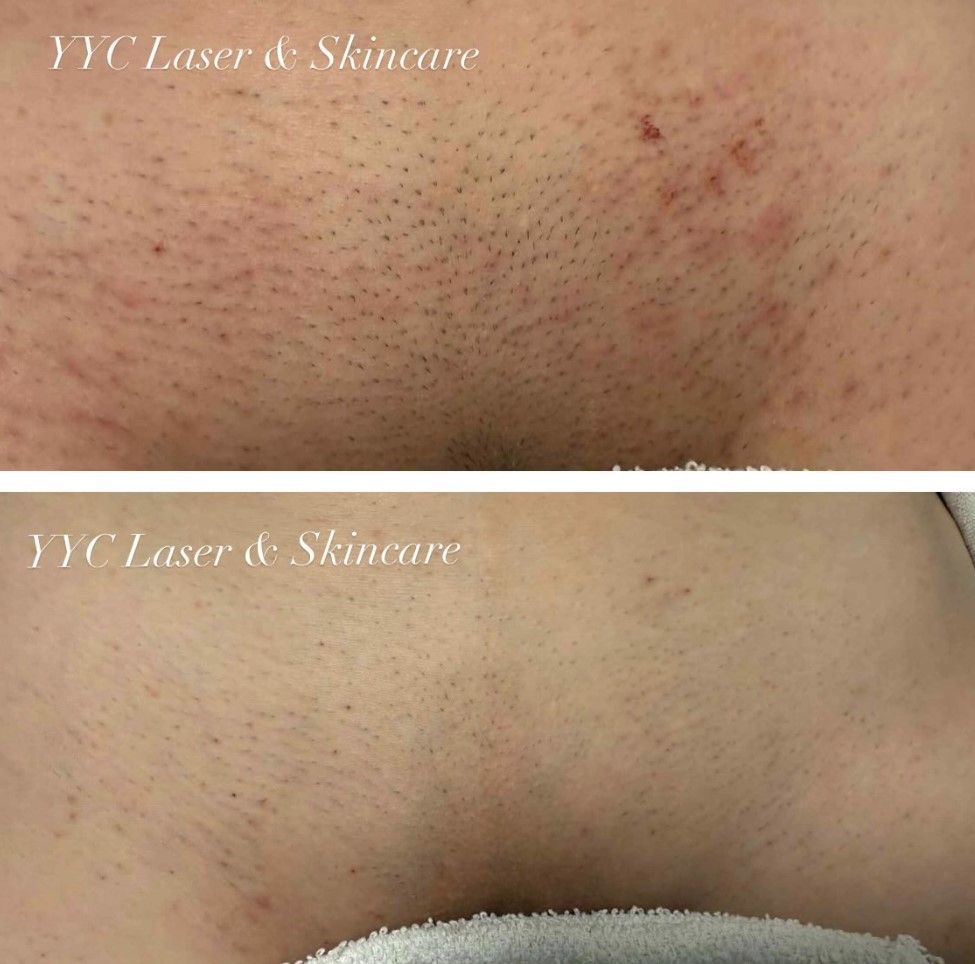 Before-and-after close-up of skin with dark spots and hair stubble, showing treatment results.