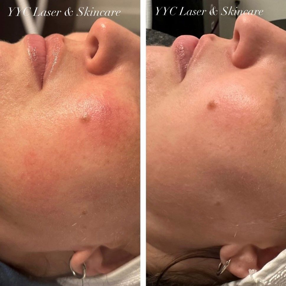 Side-by-side close-up of a cheek before and after skincare treatment, showing reduced redness and a small blemish