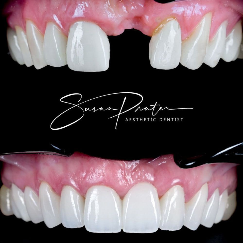 Before-and-after close-up of upper teeth with pink gums, showing improved alignment and brighter white veneers