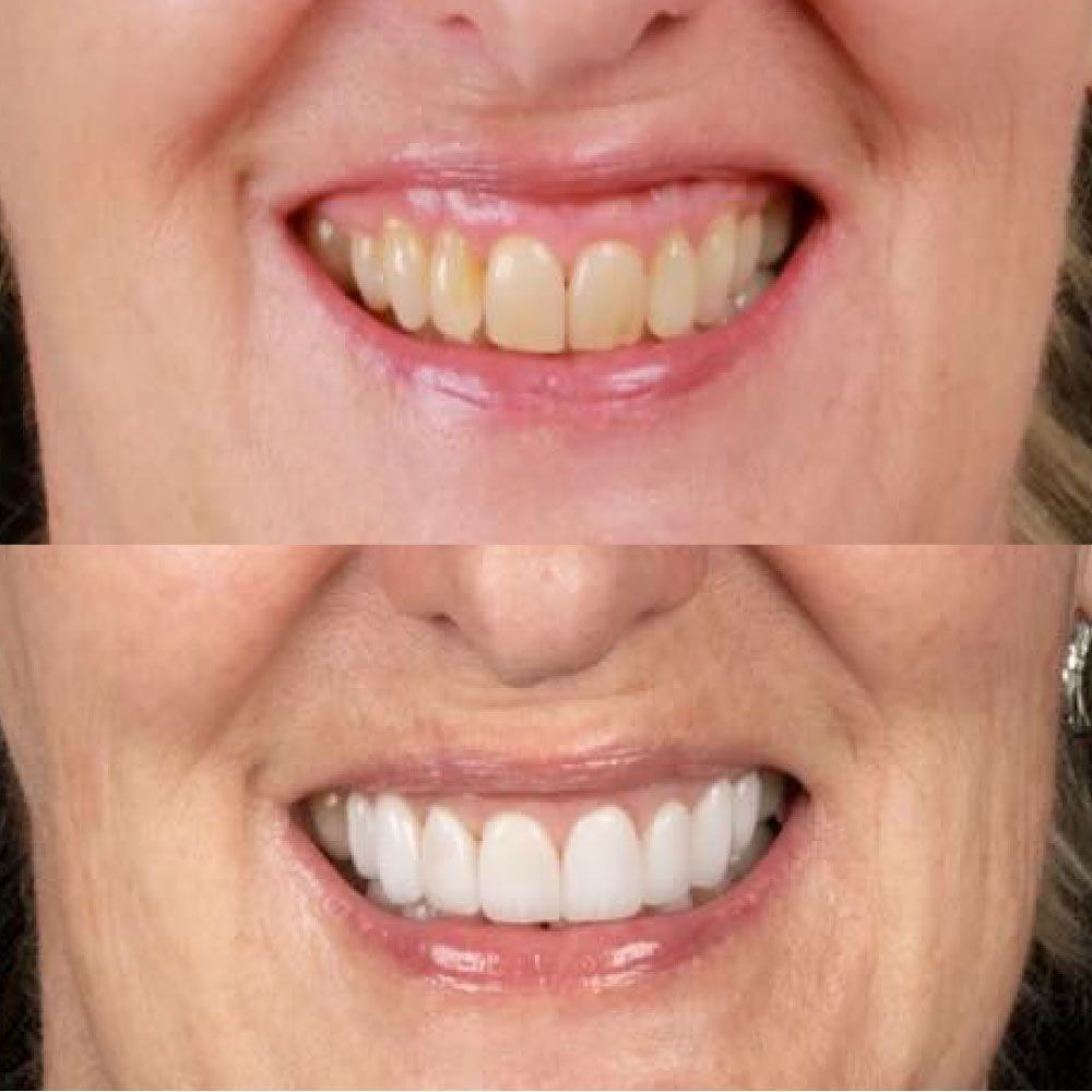 Close-up of a smile before and after teeth whitening, showing brighter white teeth on the bottom.