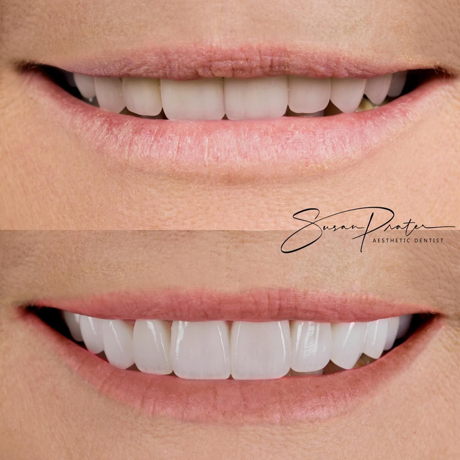 Before-and-after close-up of a smiling mouth with teeth whitening results, showing brighter white teeth below