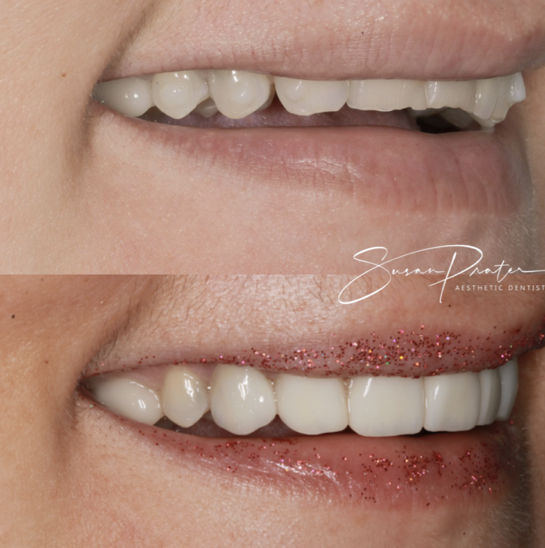 Close-up of lips showing upper and lower teeth before and after dental treatment