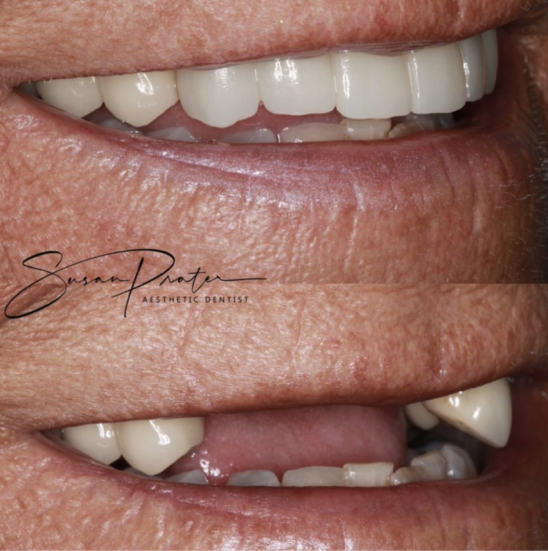 Close-up before-and-after of teeth and gums, showing dental cosmetic improvement