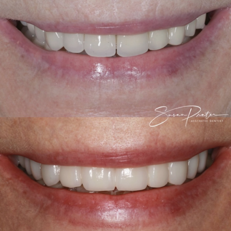 Close-up of lips before and after, showing whiter teeth and improved smile