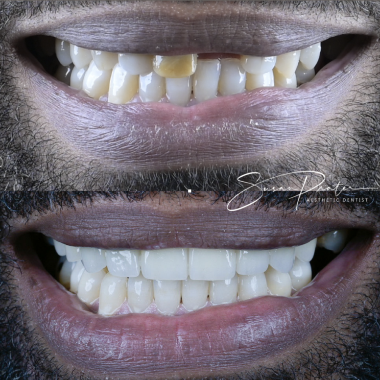 Close-up of a smile showing uneven yellowed upper teeth above brighter lower teeth