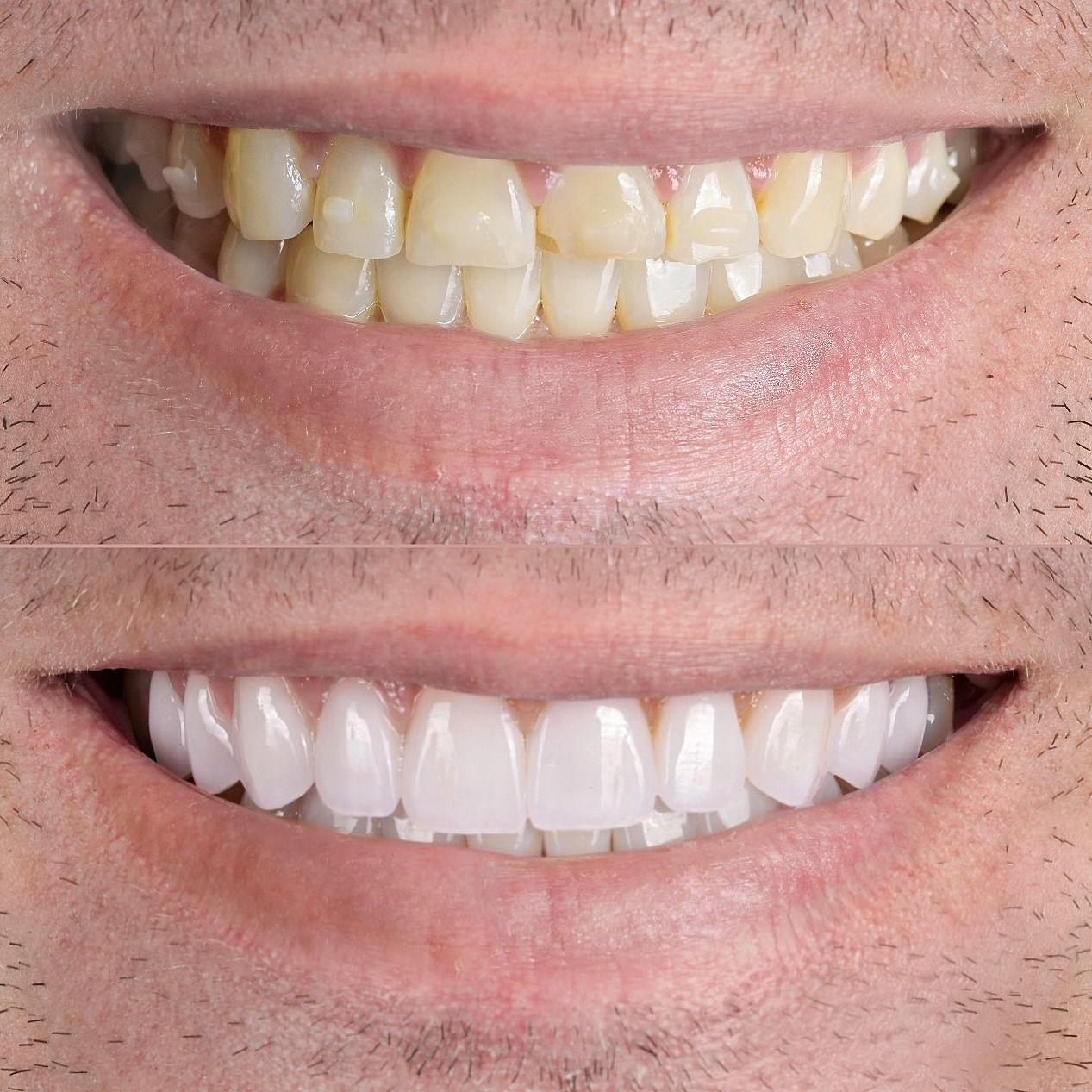 Before-and-after smile showing yellowed teeth above and whiter teeth below