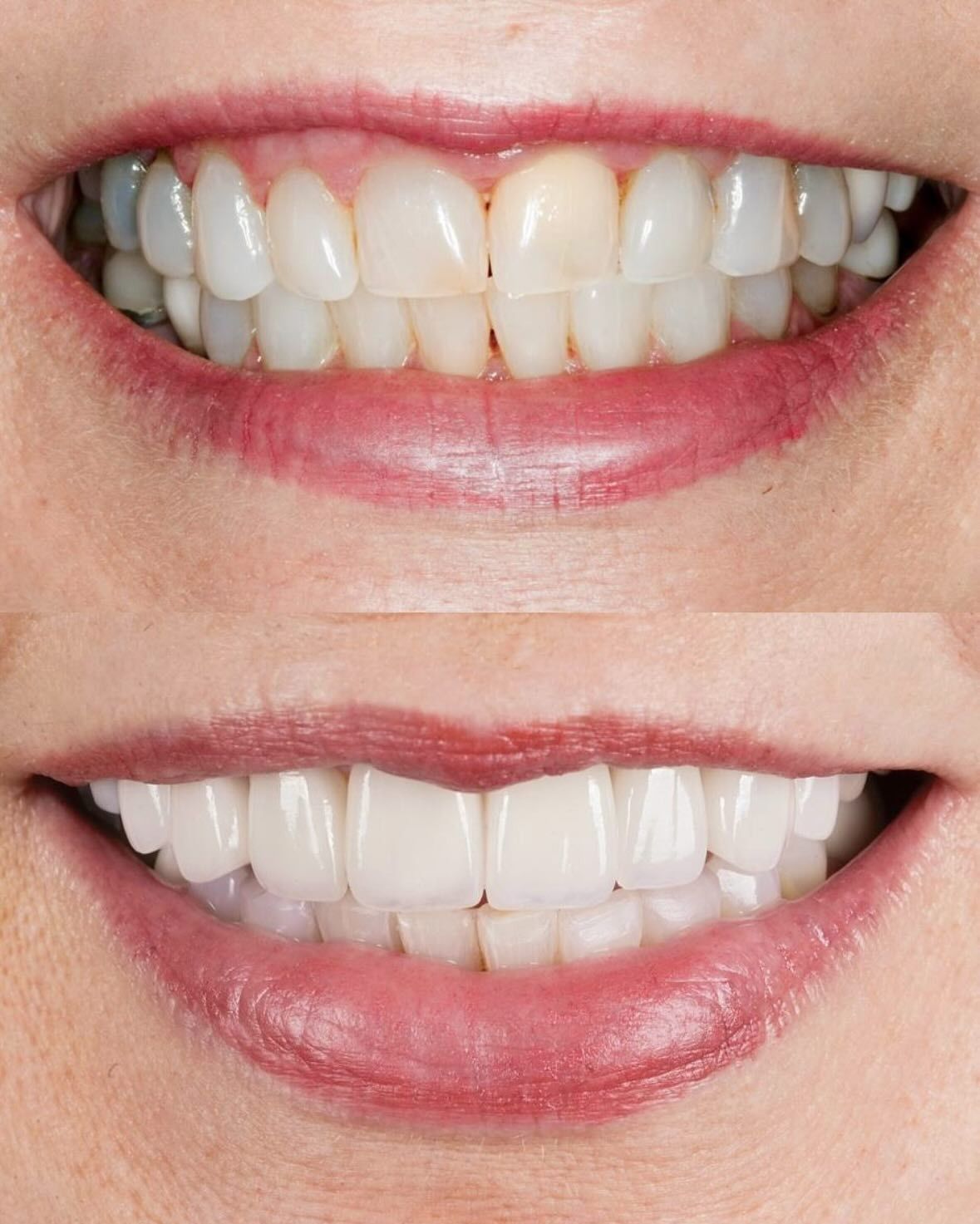 Close-up of a smiling mouth showing before-and-after teeth whitening results.