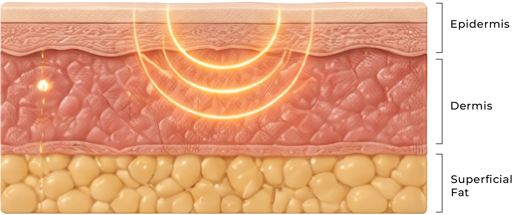 Cross-section of skin layers with orange light penetrating the epidermis and dermis.