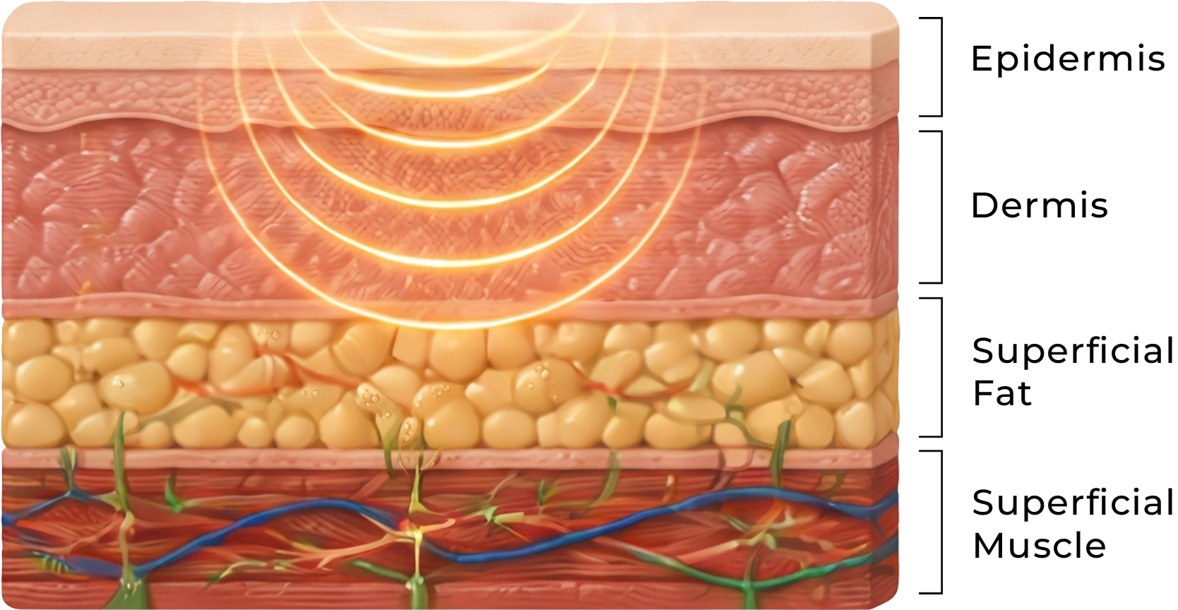 Cross-section of skin layers showing ultrasound waves penetrating epidermis, dermis, fat, and muscle.
