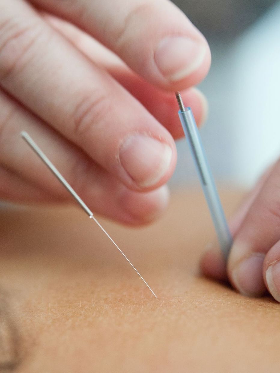 acupuncture needles