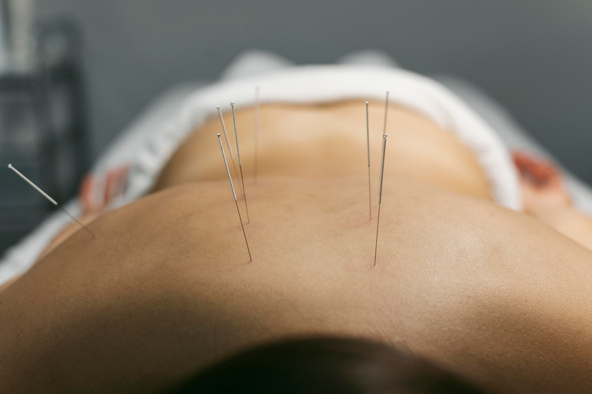 person getting acupuncture