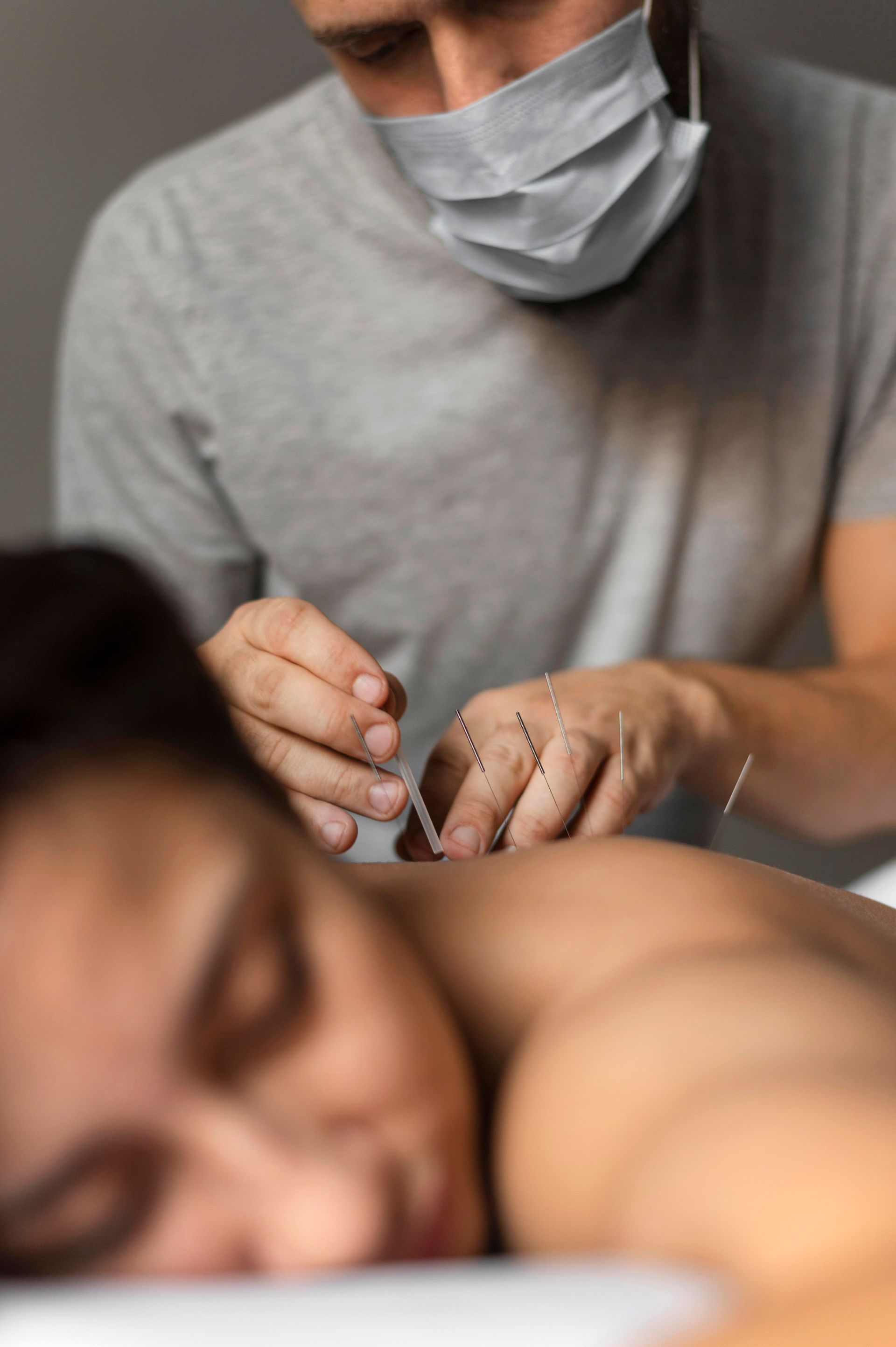 therapist doing acupuncture