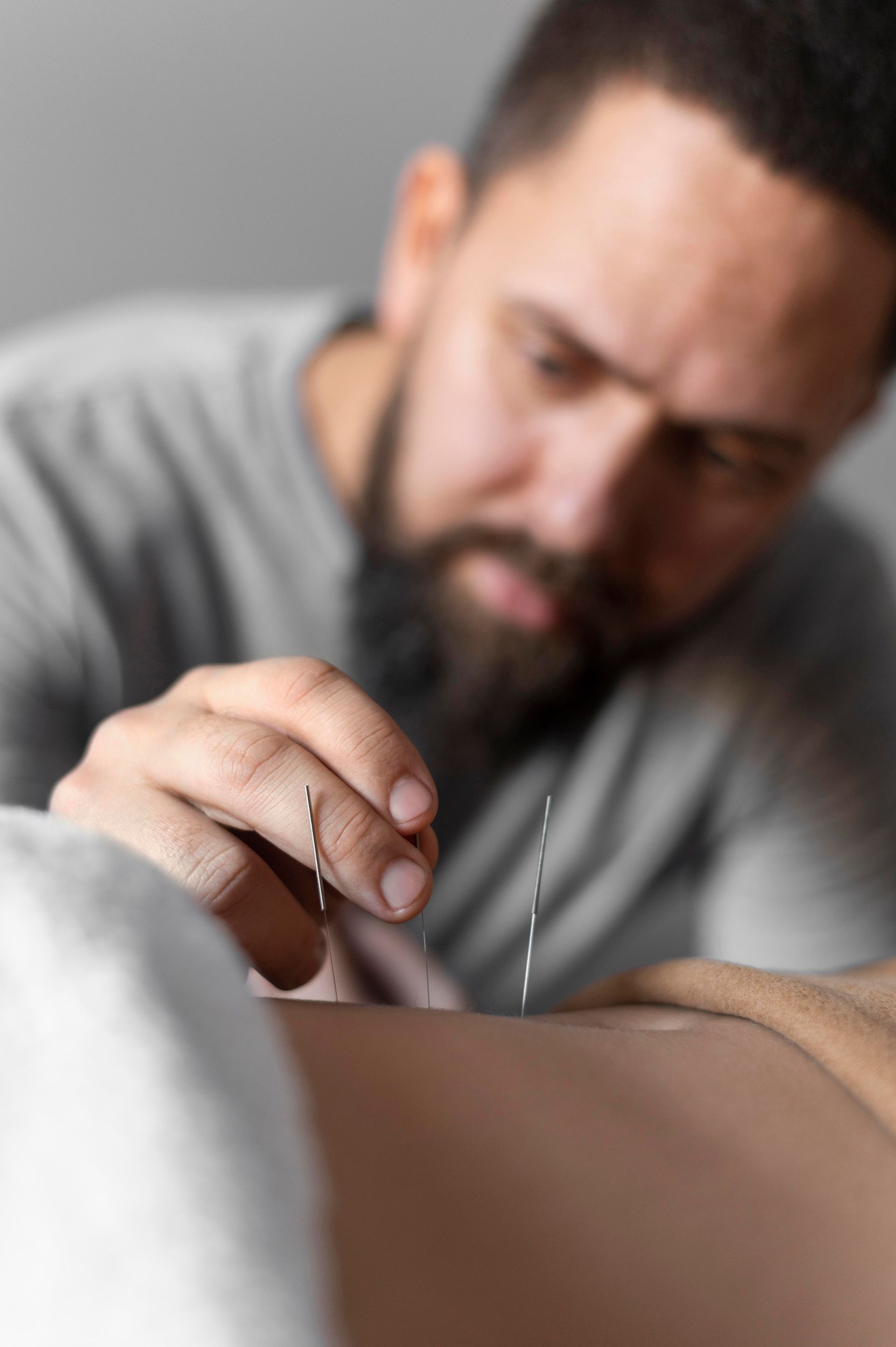 therapist holding Acupuncture needle
