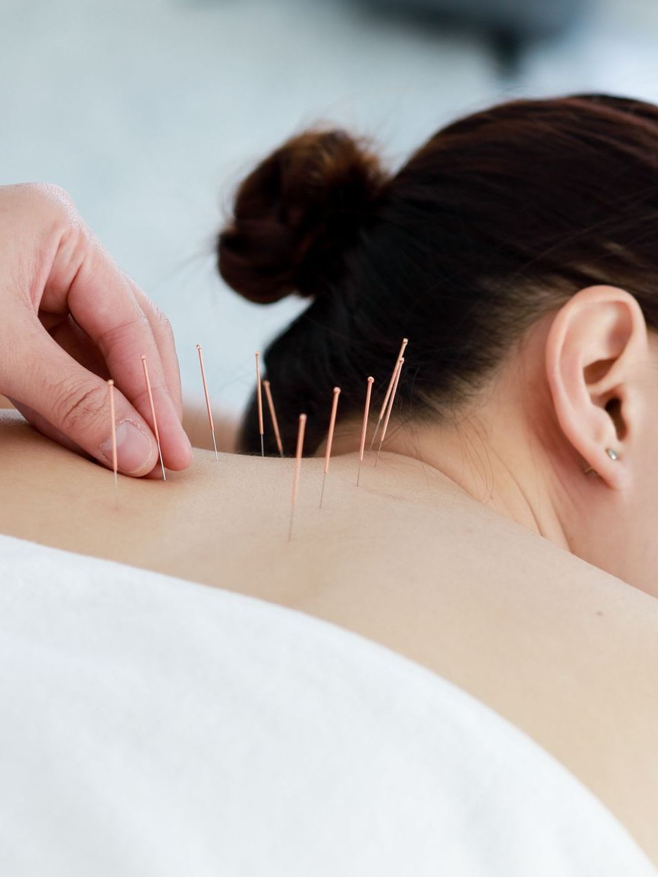 woman getting acupuncture