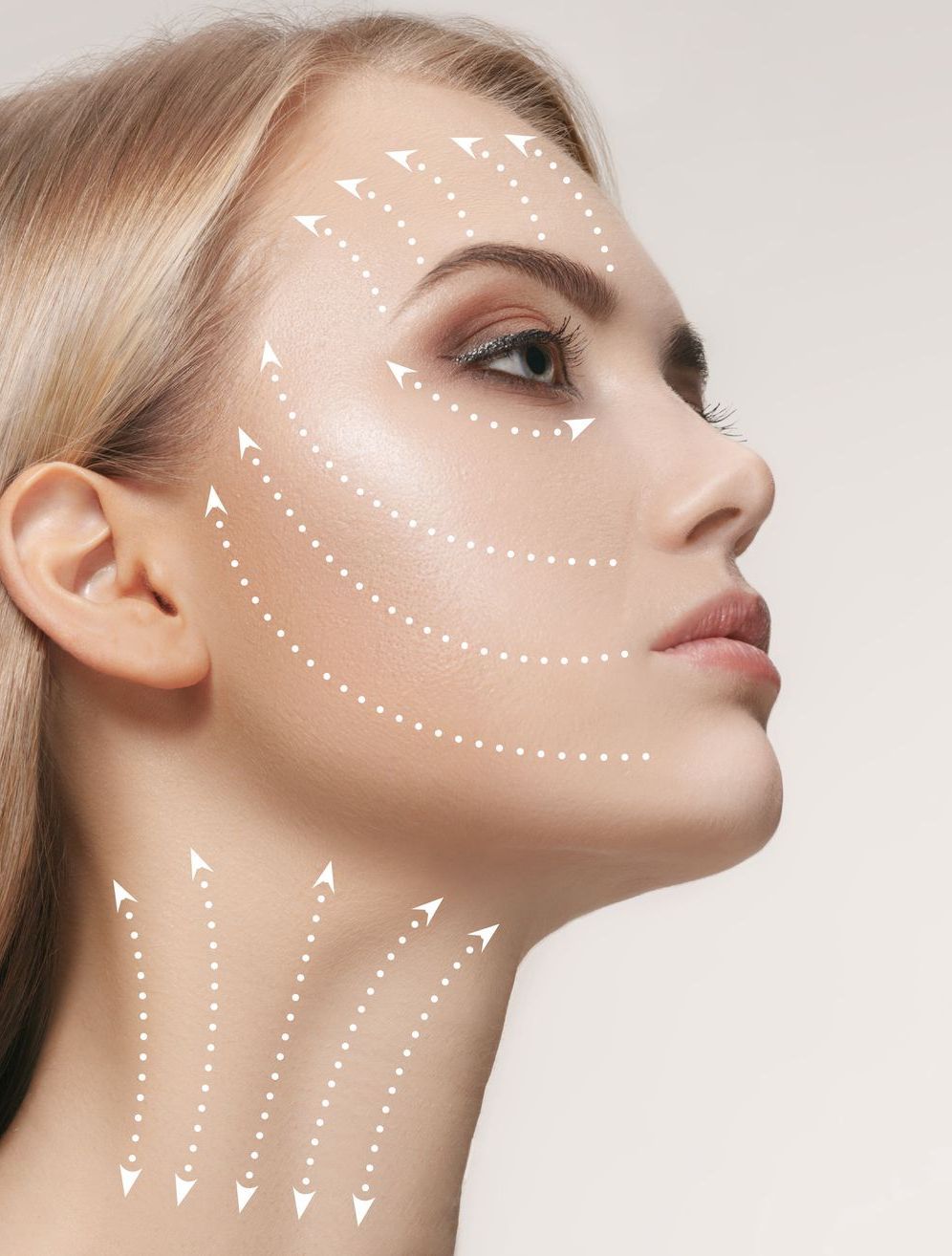 Woman's face with arrows indicating areas for a cosmetic procedure, profile view.