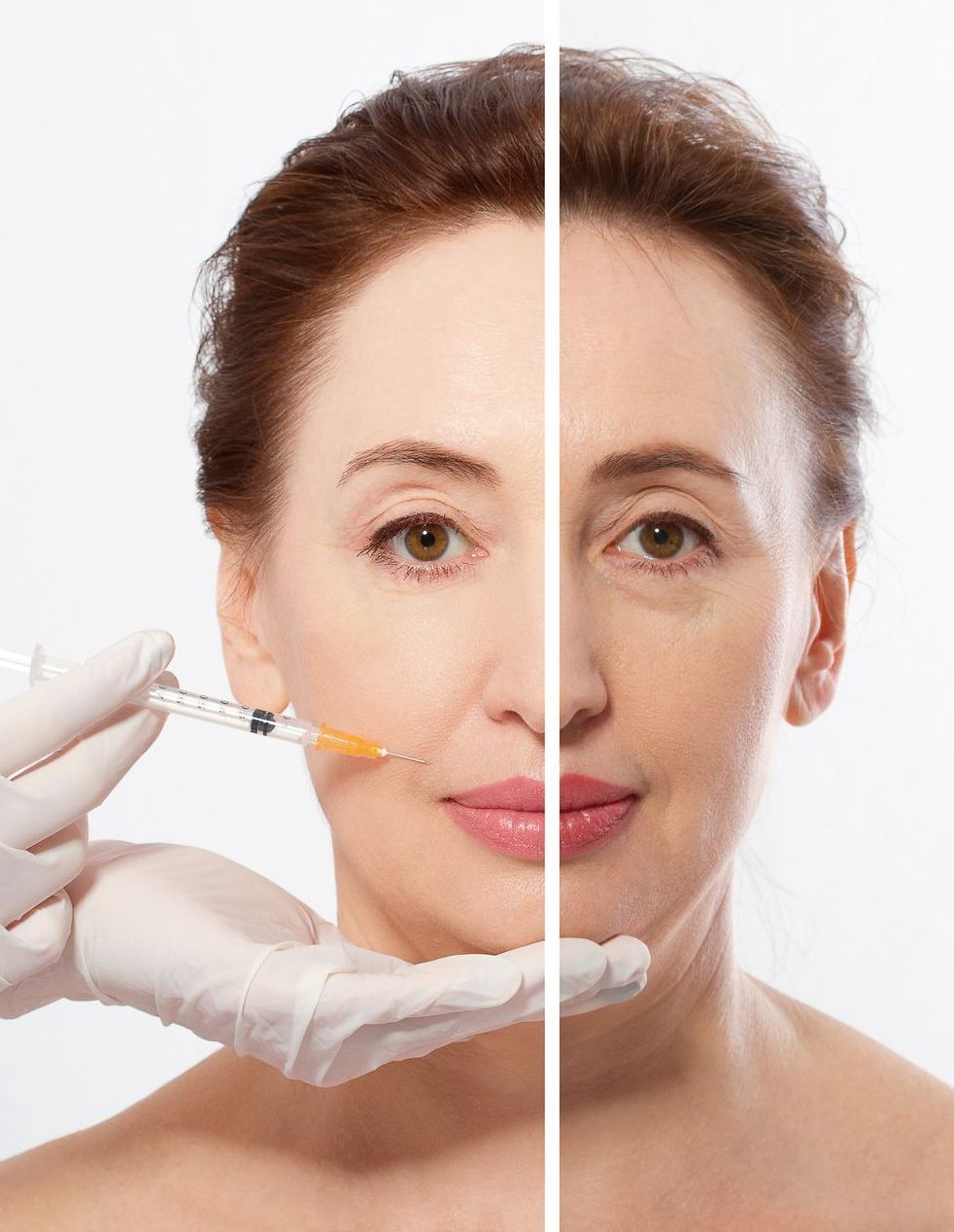 Woman's face split down the middle. Left side receiving cosmetic injection, right side shows wrinkles.
