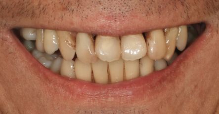 Close-up of a smiling mouth with crooked, yellowed teeth and lips slightly parted