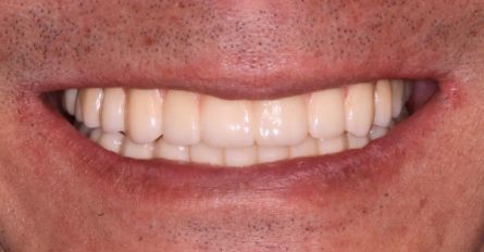 Close-up of a smiling mouth showing straight white teeth
