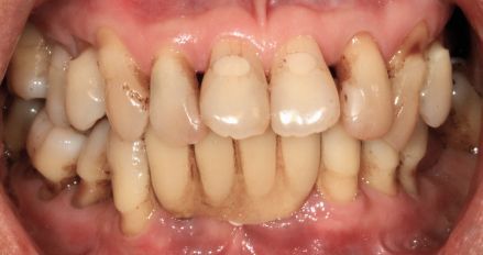 Close-up of teeth with severe crowding and misalignment, showing stained gums and dental plaque