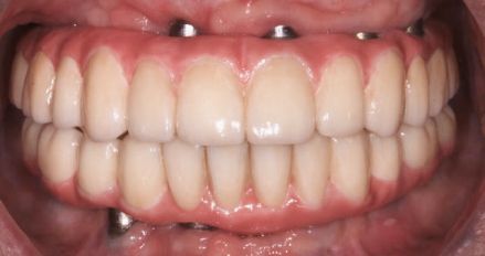 Close-up of full dentures showing upper and lower teeth with pink gums