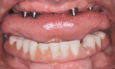 Close-up of a mouth with dental implants on the upper jaw and natural teeth below