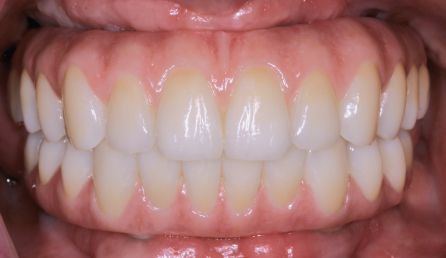Close-up of upper and lower teeth with a bright white dental prosthetic smile
