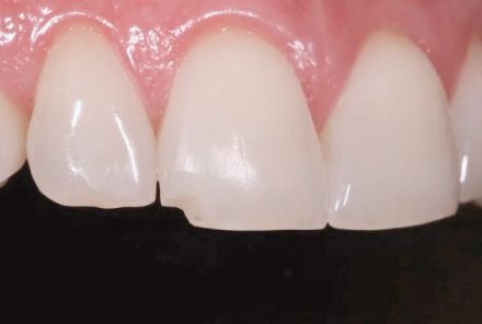 Close-up of three white front teeth with a small gap between the two center teeth.