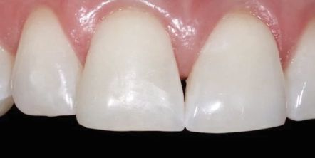 Close-up of three front teeth with a visible gap between the center teeth