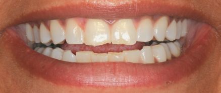 Close-up of a smiling mouth with visible teeth and lips