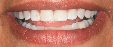 Close-up of a smiling mouth showing white teeth and pink lips