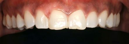 Close-up of a person's mouth showing teeth and gums with red irritation
