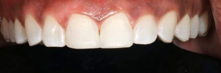 Close-up of upper front teeth with a small gap, against a dark background